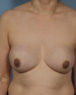 Bilateral Periprosthetic Capsulectomy (Implant & Capsule Removal)