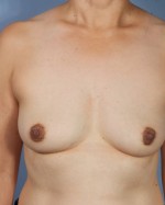 Bilateral Periprosthetic Capsulectomy (Implant & Capsule Removal)