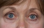 Blepharoplasty (Eyelift)