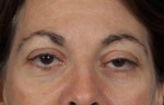 Blepharoplasty (Eyelift)