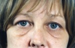Blepharoplasty (Eyelift)