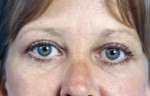 Blepharoplasty (Eyelift)