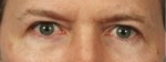 Blepharoplasty (Eyelift)