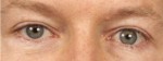 Blepharoplasty (Eyelift)