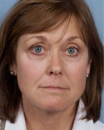 Rhytidectomy (Facelift)