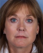 Rhytidectomy (Facelift)