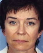 Brow Lift