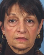 Rhytidectomy (Facelift)
