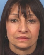 Rhytidectomy (Facelift)