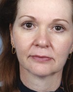 Rhytidectomy (Facelift)