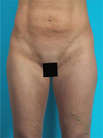 Liposuction