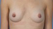 Natural Breast Enhancement (Adipose Derived Regenerative Stem Cell Enhanced Fat Injection)