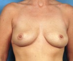 Reduction Mammoplasty (Breast Reduction)