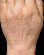 Fraxel Skin Resurfacing