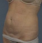 Abdominoplasty (Tummy Tuck)
