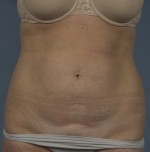 Abdominoplasty (Tummy Tuck)