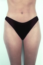 Liposuction