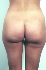 Liposuction
