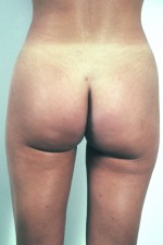 Liposuction
