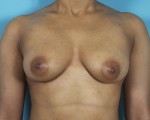 Liposuction