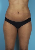 Liposuction