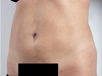 Liposuction
