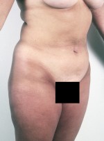 Liposuction