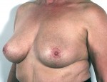 Bilateral Periprosthetic Capsulectomy + Mastopexy (Implant + Capsule Removal with Breast Lift)