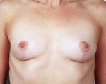 Bilateral Periprosthetic Capsulectomy + Mastopexy (Implant + Capsule Removal with Breast Lift)