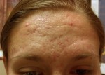 Microneedling