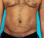 Abdominoplasty (Tummy Tuck)