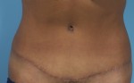 Abdominoplasty (Tummy Tuck)