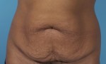 Abdominoplasty (Tummy Tuck)
