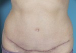 Abdominoplasty (Tummy Tuck)