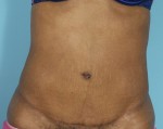 Abdominoplasty (Tummy Tuck)