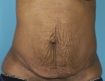 Abdominoplasty (Tummy Tuck)