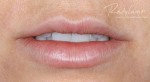Dermal Fillers