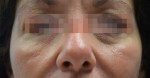 Fractora