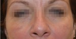 Fractora