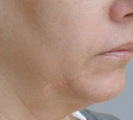 Fractora