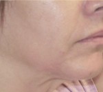 Fractora