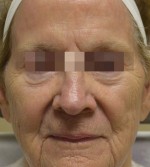 Fractora