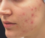 Fractora