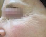 Fractora