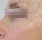 Fractora