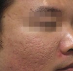 Fractora