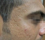 Fractora