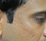 Fractora