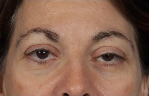 Eye lift blepharoplasty before results Case 2112 – Feng Clinic Cleveland OH