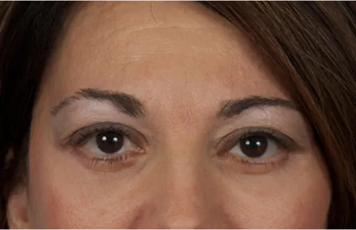 Eye lift blepharoplasty after results Case 2112 – Feng Clinic Cleveland OH